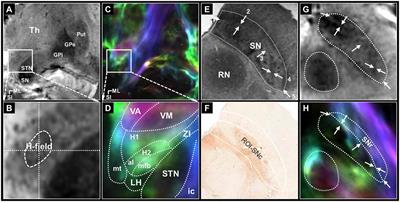 In vivo 3D Reconstruction of the Human Pallidothalamic and Nigrothalamic Pathways With Super-Resolution 7T MR Track Density Imaging and Fiber Tractography